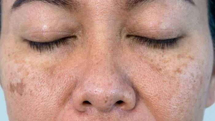 Da xỉn màu là gì? Nguyên nhân và cách khắc phục làn da xỉn màu 3