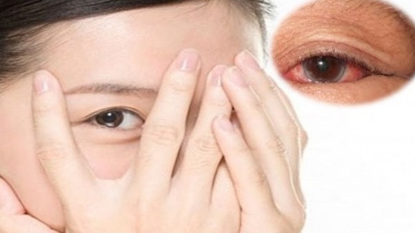 Nguyên nhân khiến mắt sưng đỏ đau rát và cách khắc phục