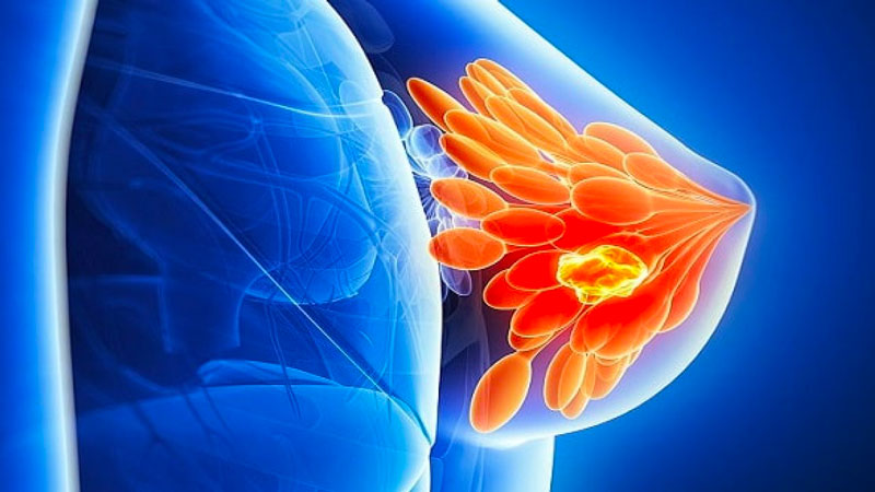 Nguyên nhân khiến ngực có cục cứng đau ảnh hưởng đến sức khỏe 1