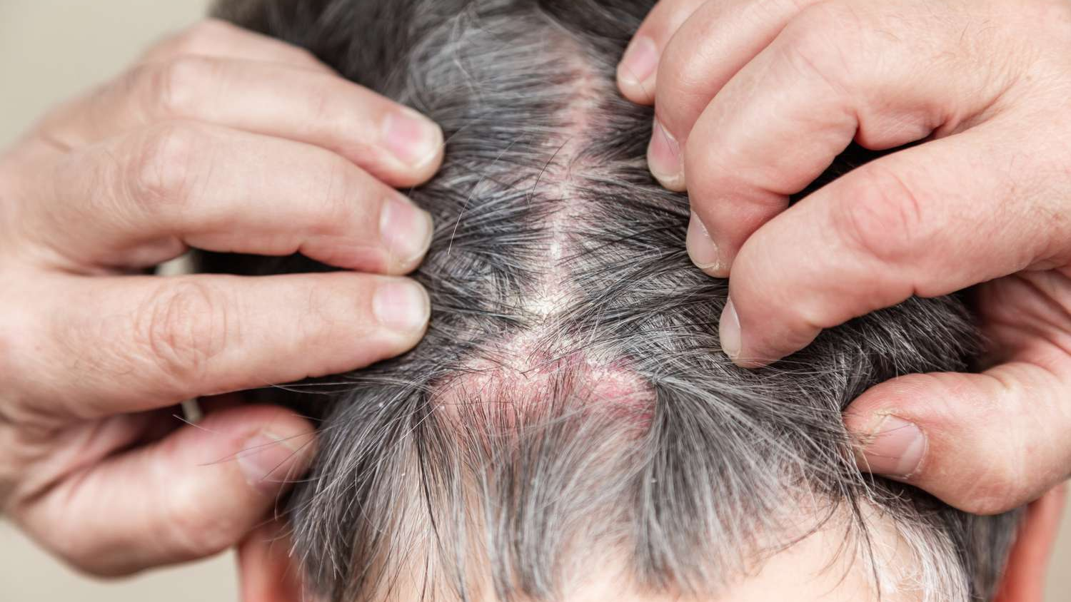 Nguyên nhân, triệu chứng và cách điều trị ghẻ da đầu