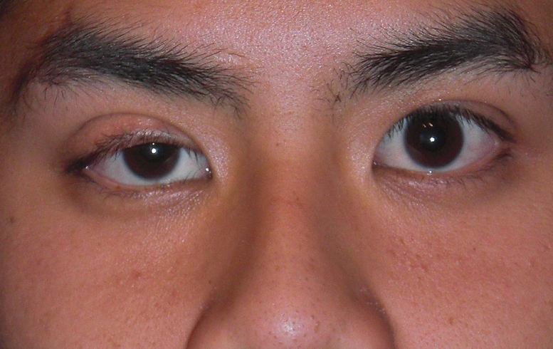 Cách chữa sụp mí mắt bằng Đông y có hiệu quả không? 3