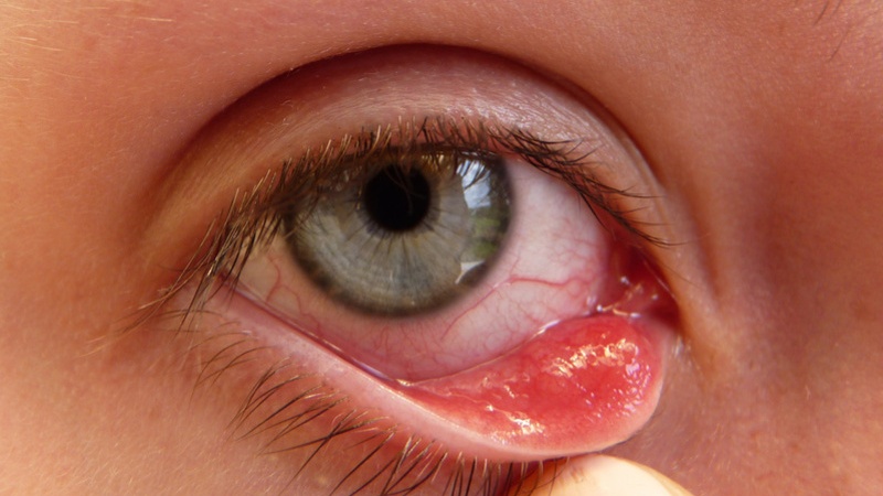 3 nguyên nhân chính gây viêm kết mạc có thể bạn chưa biết 1