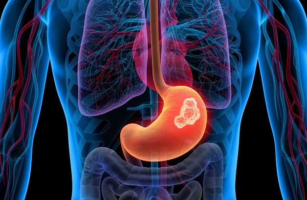 Nguyên tắc xây dựng thực đơn cho người ung thư dạ dày 1