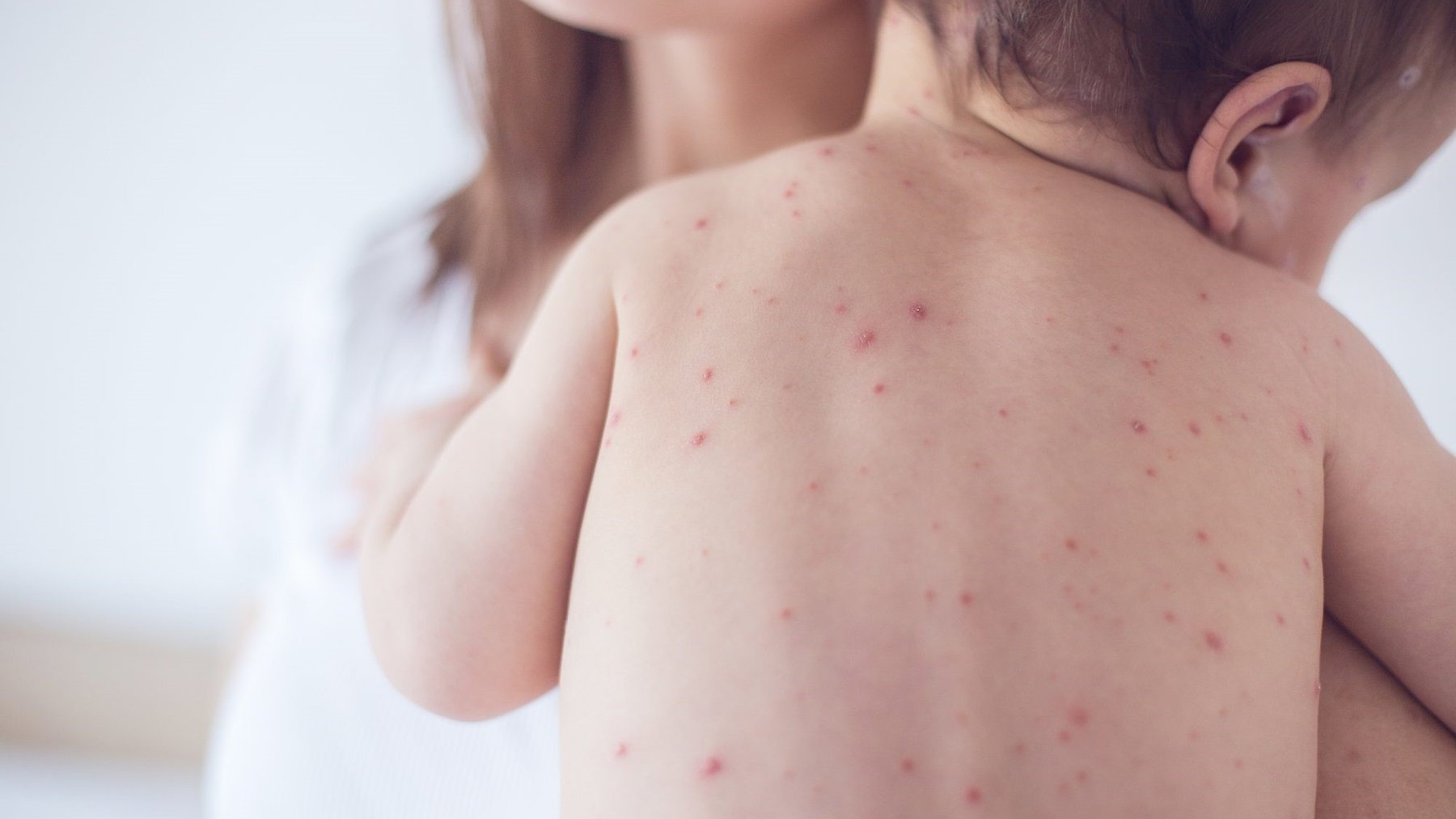 Cách nhận biết dấu hiệu sốt xuất huyết ở trẻ dưới 1 tuổi