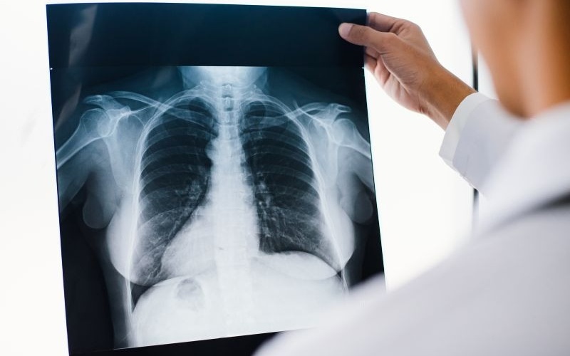 nhan-biet-day-dinh-mang-phoi-tren-hinh-anh-chup-x-quang 1.jpg