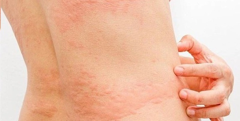 Nhiễm sán chó có nguy hiểm không? Hướng dẫn cách phòng ngừa 1