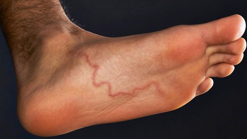 Nhiễm Strongyloides Stercoralis là gì? Nguyên nhân, triệu chứng và điều trị  2