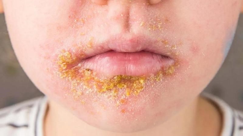 Nhiễm trùng da là gì? Những thông tin cần biết 2