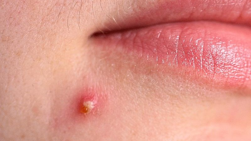 Nhiễm trùng da là gì? Những thông tin cần biết 3