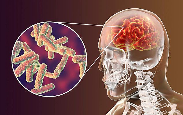 Nhiễm trùng não: Nguyên nhân và triệu chứng nhận biết 1