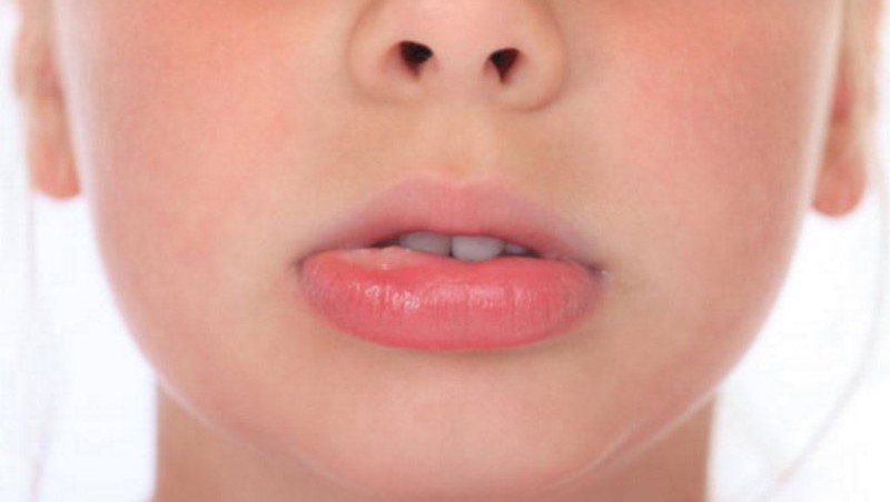 Nhiệt miệng sưng môi là gì? Nguyên nhân và cách điều trị 5
