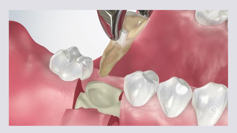 Nhổ chân răng và những thông tin quan trọng cần biết 1