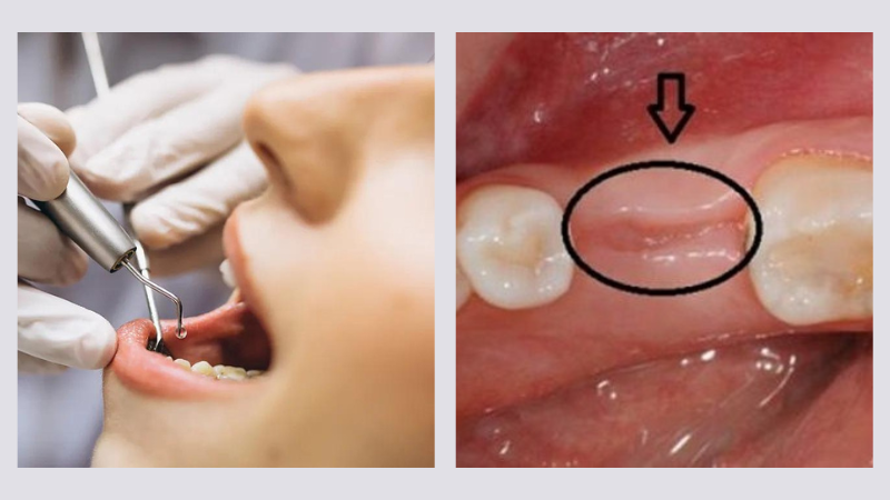 Nhổ chân răng và những thông tin quan trọng cần biết 3