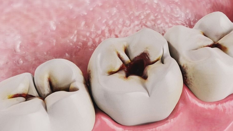 Nhổ răng hàm có đau không? Các phương pháp nhổ răng hàm phổ biến hiện nay 1