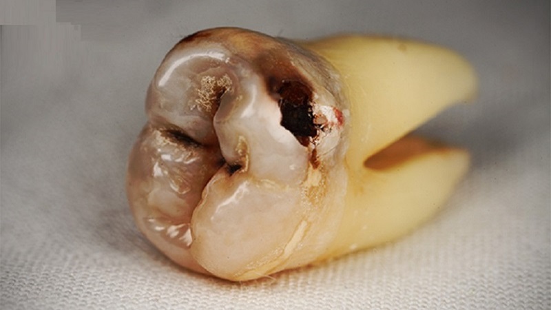 Nhổ răng khôn bị sâu hàm trên: Lợi ích và một số lưu ý 2