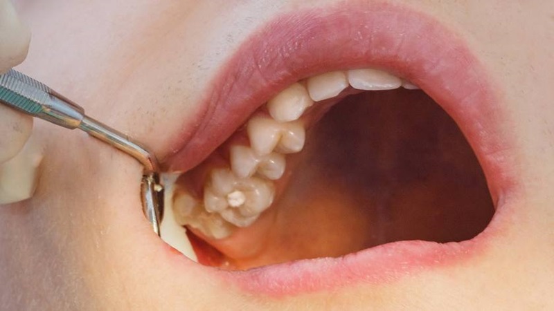 Nhổ răng khôn bị sâu hàm trên: Lợi ích và một số lưu ý 3