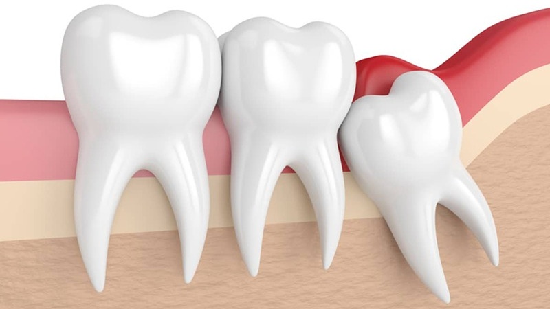 Nhổ răng khôn hàm dưới có nguy hiểm không? Những điều cần lưu ý sau nhổ răng khôn 1