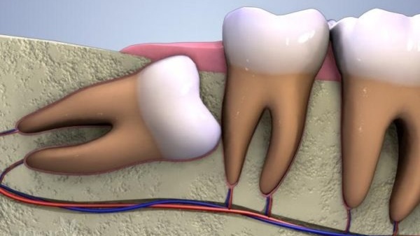 Nhổ răng khôn hàm dưới có nguy hiểm không? Những điều cần lưu ý sau nhổ răng khôn 2