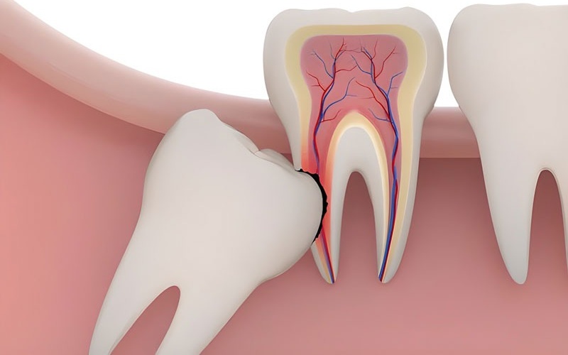 Nhổ răng khôn hàm trên có nguy hiểm không? Các nguy cơ có thể xảy ra 1