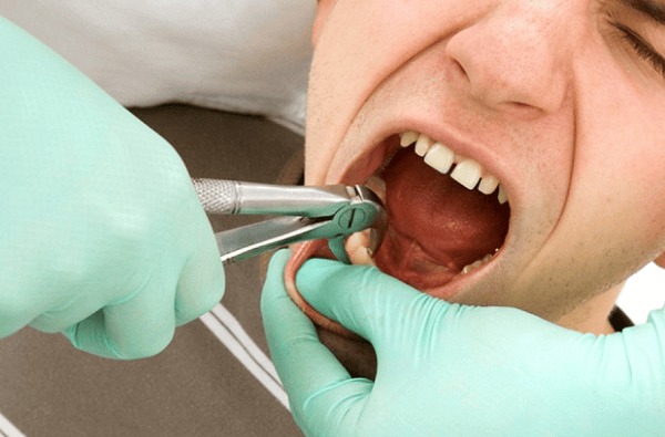 Nhổ răng khôn hàm trên có nguy hiểm không? Các nguy cơ có thể xảy ra 3