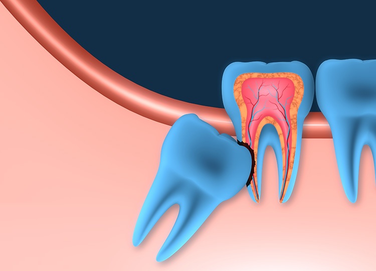 Nhổ răng khôn sau bao lâu cắt chỉ? Vì sao cần cắt chỉ sau nhổ răng khôn? 1