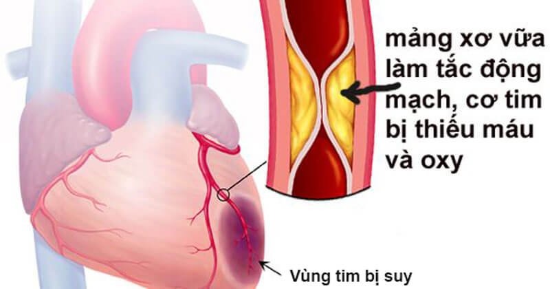 Nhồi máu cơ tim ở người trẻ do đâu? Nhồi máu cơ tim ở người trẻ có nguy hiểm không? 4