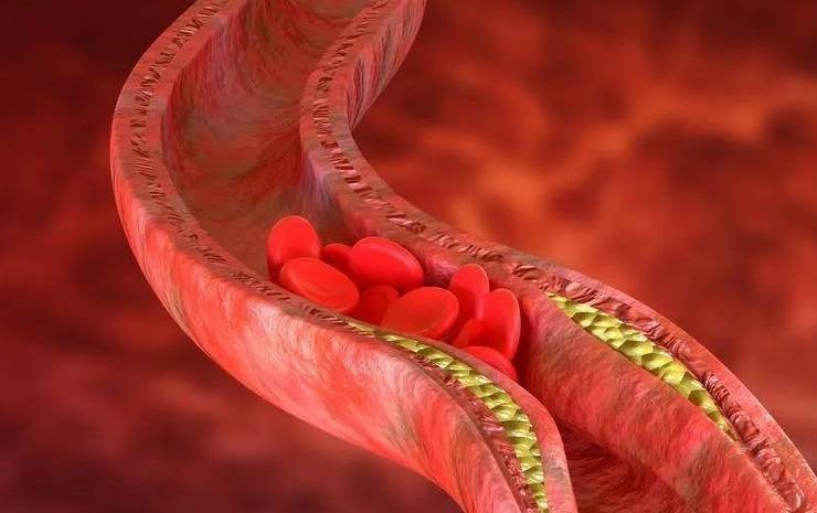 Nhồi máu não bán cầu phải: Nguyên nhân, triệu chứng, chẩn đoán và điều trị 3