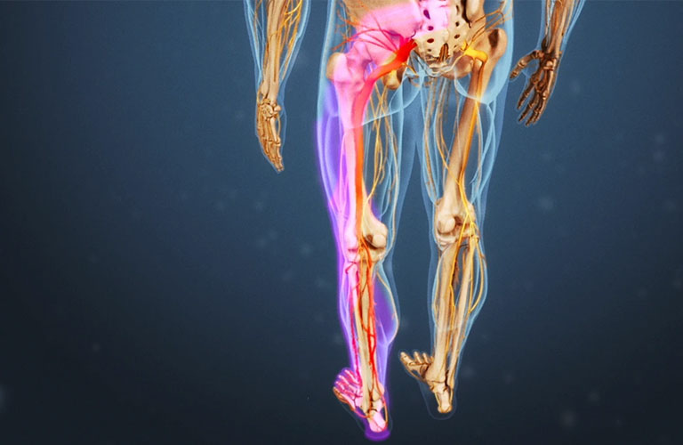 Những biến chứng của thoát vị đĩa đệm gây tê chân ảnh hưởng sức khỏe 3