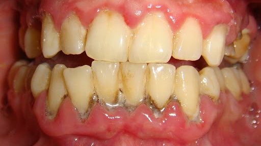 Bị viêm nha chu có lây không? - Long Châu