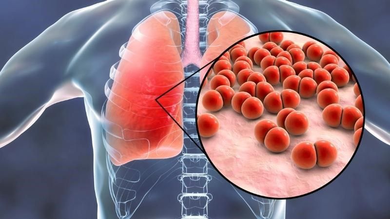 Những điều bạn cần biết về vắc-xin pneumococcal 1