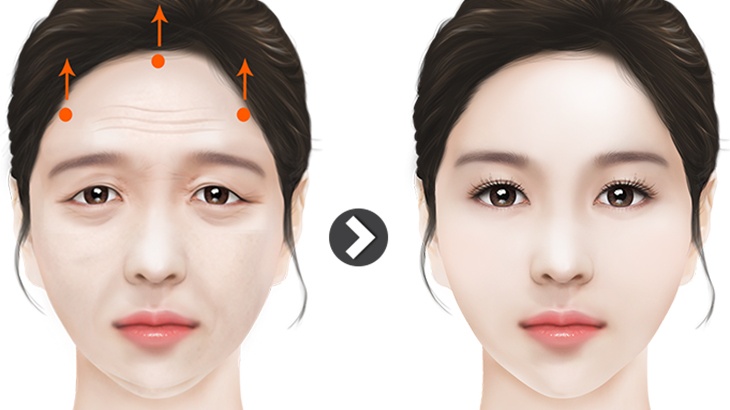 Những điều bạn cần biết về căng da mặt phẫu thuật 3