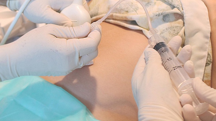 Những điều cần biết về chọc dò dịch ối và sinh thiết tua nhau thai 3