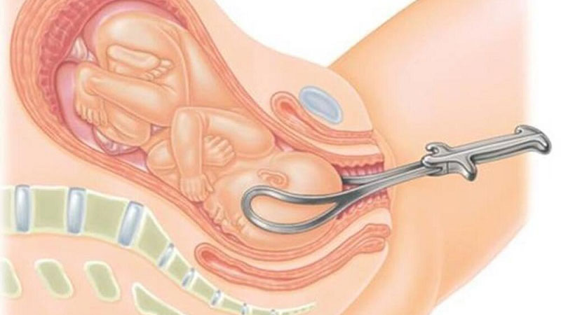 Những điều cần biết về kỹ thuật hỗ trợ sinh con bằng Forceps 1