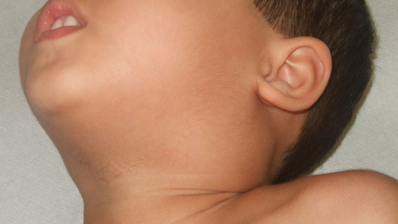 Những điều cần biết về tình trạng trẻ nổi hạch ở cổ lâu ngày 1