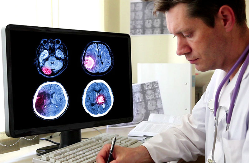 Những điều cần biết về u não giai đoạn đầu và cách điều trị 2