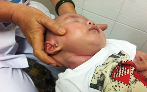 những điều cần biết về xơ hóa cơ ức đòn chũm ở trẻ 4