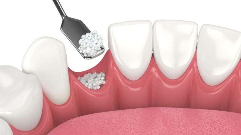 Những điều cần lưu ý sau phẫu thuật ghép xương ổ răng 1