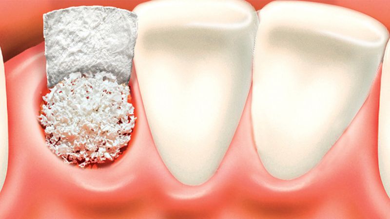 Những điều cần lưu ý sau phẫu thuật ghép xương ổ răng 3
