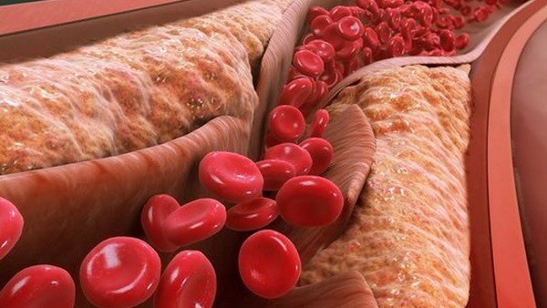 nhung-hau-qua-cua-xo-vua-dong-mach-ma-ban-nen-biet 1.jpg