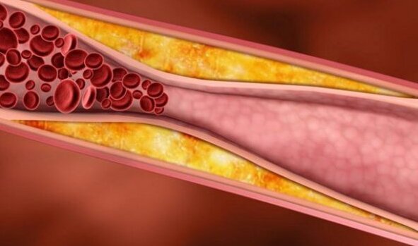 nhung-loai-thuoc-dieu-tri-xo-vua-dong-mach-hieu-qua 1.jpg