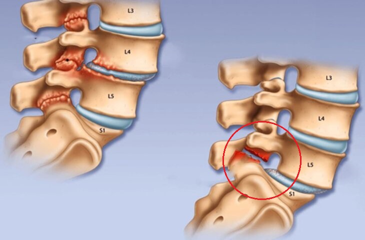 Những lưu ý khi điều trị đau thần kinh tọa ở người già 4