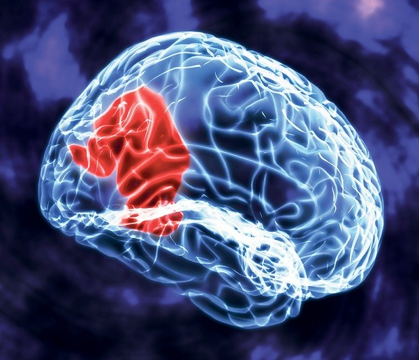 Những phương pháp điều trị u màng não hiệu quả, phổ biến nhất mà bạn nên biết 4