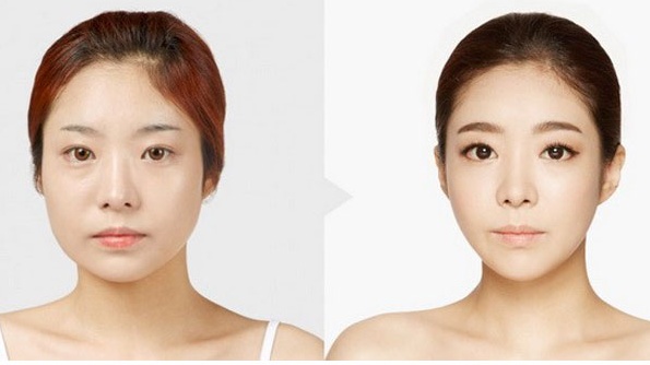 4 phương pháp làm gọn mặt không cần phẫu thuật  2