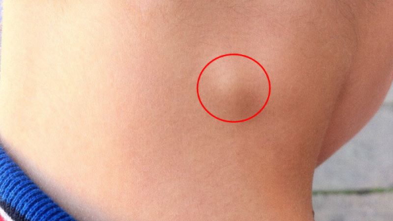 Những thông tin cần biết về bệnh U lympho Burkitt 1