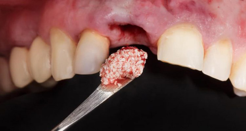 Những thông tin cần biết về kỹ thuật ghép xương răng