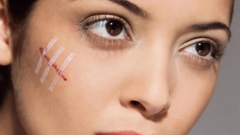 Những thực phẩm cần tránh sau khi thực hiện khâu thẩm mỹ vết thương ở mặt 1