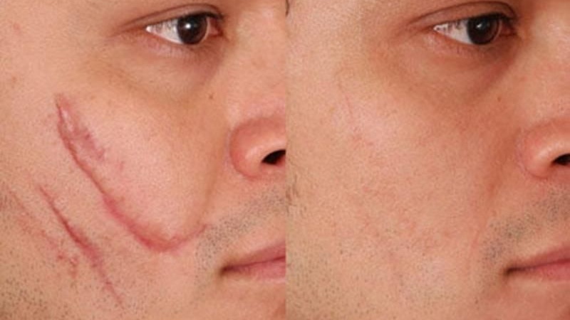 Những thực phẩm cần tránh sau khi thực hiện khâu thẩm mỹ vết thương ở mặt 2