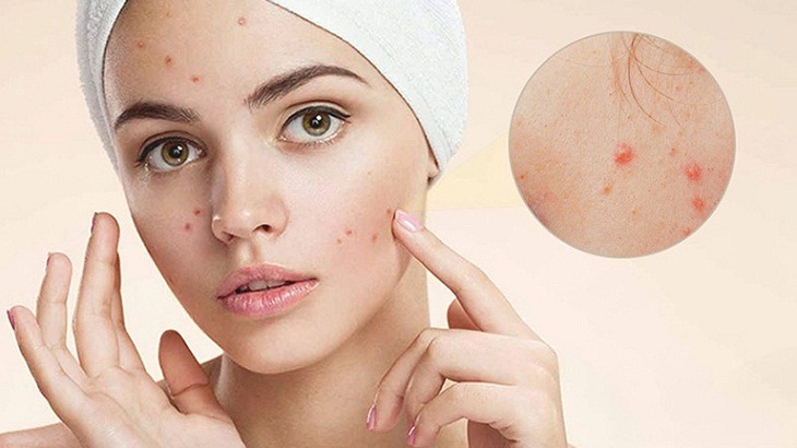 Niacinamide dùng sáng hay tối mới tốt? Cần lưu ý những gì? 2