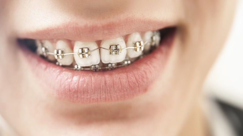 Niềng răng bị gò má cao phải làm sao? Khắc phục như thế nào? 1