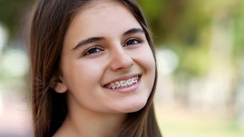 Niềng răng bị mỏi hàm: Nguyên nhân và cách khắc phục nhanh nhất 2